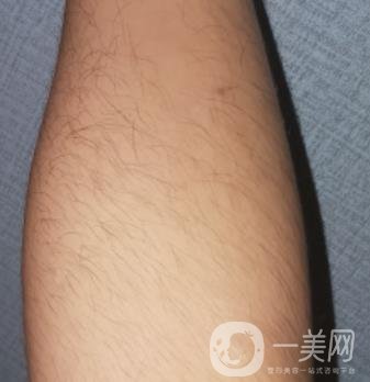 哈醫(yī)大四院整形美容科價(jià)格表鉅惠來襲，附冰點(diǎn)脫毛案例
