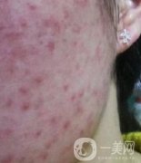 成都軍區(qū)總醫(yī)院整形美容科價格表及祛痘印真人日記