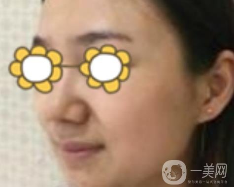 阜陽(yáng)市人民醫(yī)院整形美容科價(jià)格表2020版，附*案例