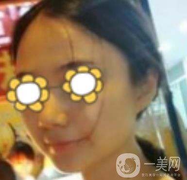 阜陽(yáng)市人民醫(yī)院整形美容科價(jià)格表2020版，附*案例