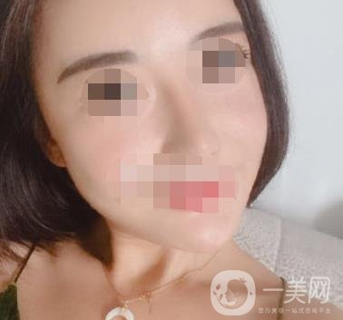 哈爾濱醫(yī)大二院整形美容科價(jià)格表上線，附*案例