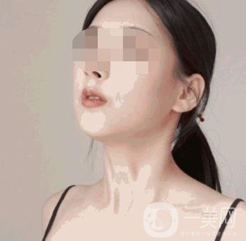 河南省人民醫(yī)院整形美容科價(jià)格表公布，附除腋臭案例