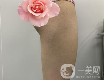 邢臺人民醫(yī)院整形美容科價格表，附大腿吸脂案例