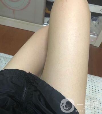 邢臺人民醫(yī)院整形美容科價格表，附大腿吸脂案例