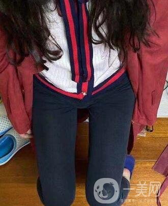 邢臺人民醫(yī)院整形美容科價格表，附大腿吸脂案例