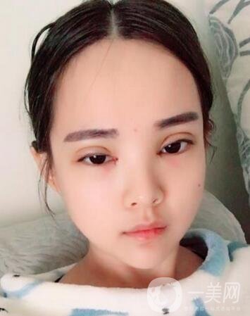 湖南第一醫(yī)院整形科價(jià)格表，附雙眼皮案例