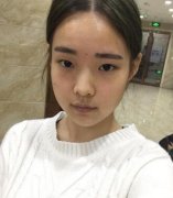 湖南湘雅醫(yī)院整形科價格表，附雙眼皮案例