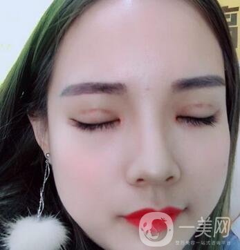 湖南第一醫(yī)院整形科價(jià)格表，附雙眼皮案例