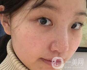 青島青醫(yī)附院整形價格表，還有雙眼皮實例
