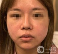 常州第一人民醫(yī)院*案例果及整形價格表分享