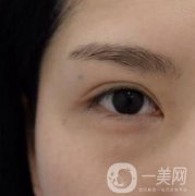 廣州人民醫(yī)院整形價格表，附去眼袋案例