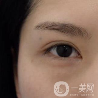 廣州人民醫(yī)院整形價格表，附去眼袋案例
