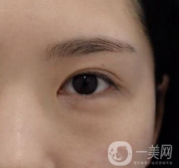 廣州人民醫(yī)院整形價格表，附去眼袋案例