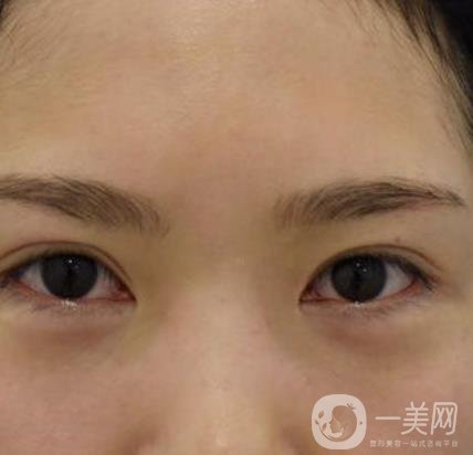 廣州人民醫(yī)院整形價格表，附去眼袋案例