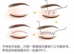 雙眼皮成型方法有哪些？好處有啥？