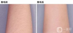 激光手臂脫毛之后會不會在長？專家揭秘脫毛的優(yōu)點