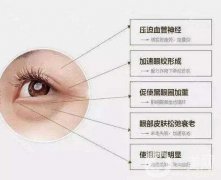 超聲波去眼袋果好嗎？看文章里面都解釋清楚了