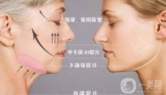 打了“*”就能消除魚尾紋！注射之前先了解這些幾點