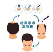 植發(fā)前需要注意哪些細(xì)節(jié)！看完漲知識(shí)了