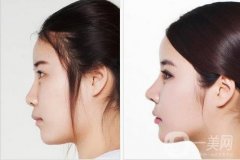 單純隆鼻與綜合隆鼻的區(qū)別是啥？想做好鼻子的就仔細(xì)看文章