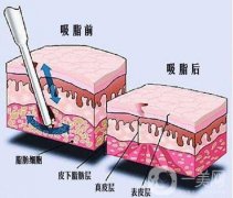 大腿吸脂手術(shù)多久可以恢復(fù)