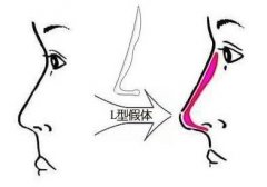 假體隆鼻感染前期癥狀