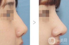 假體隆鼻可以維持多少年