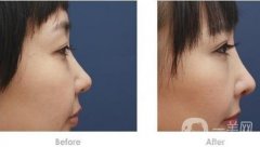 假體隆鼻兩個(gè)月可以取出來嗎