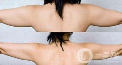 兩個(gè)手臂抽脂要多少錢(qián)