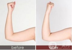 吸脂手術(shù)后疼痛感多久消失