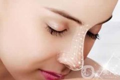 做假體隆鼻有后遺癥嗎