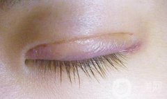 三點(diǎn)雙眼皮可以維持多久?埋線(xiàn)雙眼皮手術(shù)有什么要求?