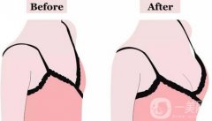 自體脂肪隆胸一般要多少錢呢?自體隆胸手術疼嗎?要注意什么?