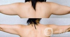 手臂抽脂后第二天可以上班嗎?手臂抽脂需要請假幾天?