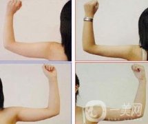 手臂抽脂疼嗎?手臂抽脂多久能恢復正常?