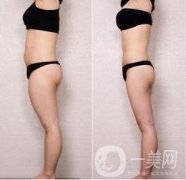 腿部吸脂多少錢?腿部抽脂后需要注意什么?