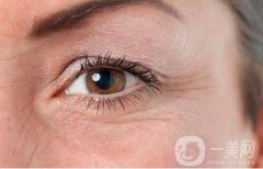 激光去魚尾紋多少錢?術前注意事項盤點