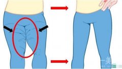 腿部抽脂后如何進(jìn)行術(shù)后護(hù)理呢?注意要點(diǎn)須知