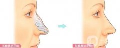 如何區(qū)分駝峰鼻是否需要矯正?有哪些矯正的方式?