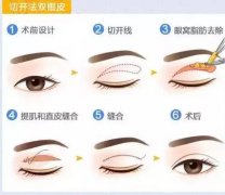 單眼皮怎么變成雙眼皮?雙眼皮手術(shù)的流程是怎樣的?