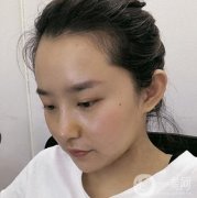 上海九院丁偉醫(yī)生隆鼻咋樣？收費(fèi)貴嗎？看價(jià)格收費(fèi)表&案例深入了解