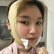 湘雅三醫(yī)院整形科價(jià)格表全新出爐！磨骨案例果圖同步公開(kāi)~