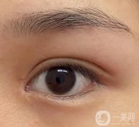 雙眼皮手術需要多久才能恢復呢?影響腫脹的因素有哪些?