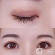 處雙眼皮價(jià)格多少?處的整形醫(yī)生怎么樣?