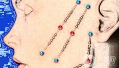 電波拉皮需要多少錢？