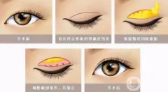 雙眼皮價格不一樣是怎么回事?雙眼皮多久能恢復自然?
