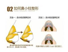 鼻小柱延長(zhǎng)會(huì)不會(huì)漏出鼻孔？延長(zhǎng)鼻小柱的方法有哪些？