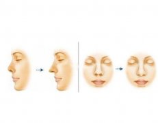 鼻小柱延長(zhǎng)失敗如何修復(fù)？術(shù)后可能出現(xiàn)的風(fēng)險(xiǎn)？