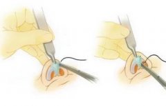 耳軟骨可以用來延長鼻小柱嗎？延長鼻小柱有什么作用？