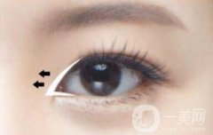 開(kāi)眼角留疤了怎么辦，如何預(yù)防?